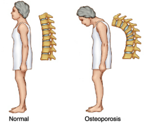 osteoporosis1