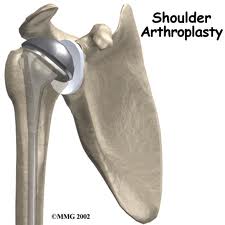 shouldertsa
