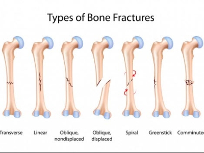  Is it a fracture or is it broken